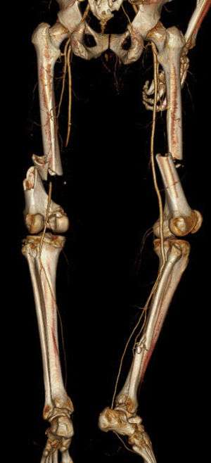 Fratura diafisária de ambos os fémures com oclusão da artéria femoral superficial esquerda (vista posterior).