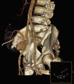 Renal artery allograft anastomotic pseudoaneurysm (CTA).