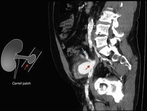 Renal allograft anastomotic pseudoaneurysm originating in the Carrel implantation patch (red arrow). Renal graft main artery (blue arrow).