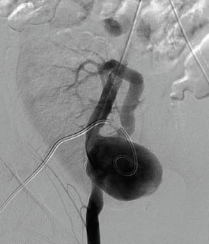 Angiographic image of the anastomotic pseudoaneurysm for interventional planning.