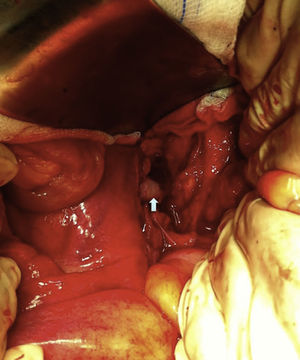 Renal allograft artery re-implantation on the external iliac artery in a termino-terminal fashion (arrow).