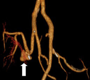 Falso aneurisma anastomótico e oclusão distal da artéria ilíaca externa.