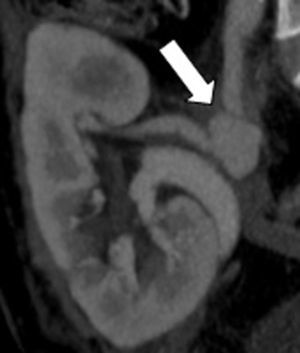 Falso aneurisma da anastomose enxerto venoso‐artéria renal.