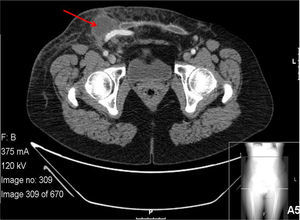 Right periprosthetic abscess.