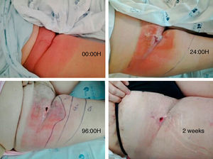 Evolution of groin infection.