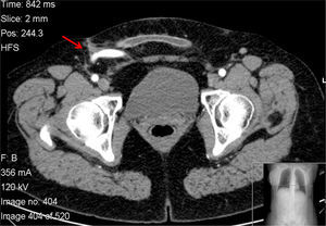 CT scan, 1 year follow-up.