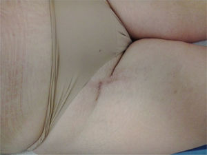 Right groin, 2-year follow-up.