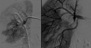 Doente 3, angiografia antes e após embolização de FA em ramo da artéria renal direita.