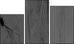 Angiografia após oclusão de bypass. Observa‐se ausência de fluxo no setor femoropoplíteo, com repermeabilização da artéria tibial posterior e peroneal.