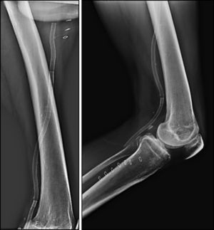 Estudo radiográfico após implante do stent Supera® em extensão do membro e flexão do joelho.