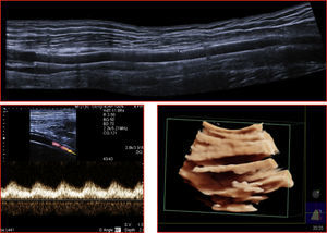 Estudo ecográfico com avaliação fluxométrica e visualização intraluminal 2D e 3D do stent.