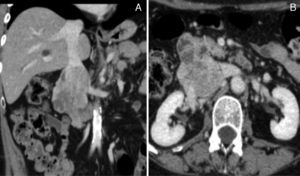 (A) and (B) Contrast CT scan demonstrating a large neoformation centered to the IVC at the renal veins level, with heterogeneous uptake of iodinated contrast media and about 8cm long axis. It presents expansive characteristics and extends beyond the boundaries of the vein, losing cleavage surface with the duodenal arch, but without reaching the pancreas. There is thrombosis of infra-renal IVC and right common iliac vein, and patent renal veins.