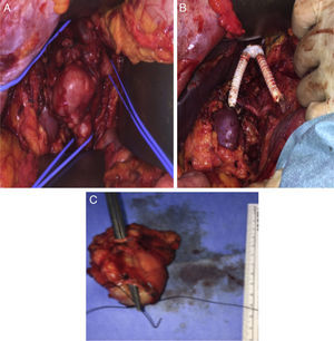 (A) Inferior vena cava with left renal vein exposed (right). (B) Final reconstruction with a new IVC bifurcation at the supra-renal level with a bifurcated 18mm×9mm PTFE graft, followed by graft extension to both renal veins using externally-supported 8mm PTFE grafts. (C) Tumor.