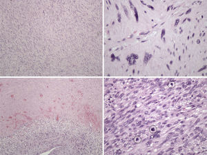 Tumor composed of interwoven bundles of spindle cells with eosinophilic cytoplasm and elongated nuclei, centrally located. There are moderate pleomorphism, areas of necrosis and counted 21 mitoses/10 HPF.