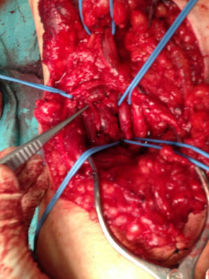 Artéria e veia poplíteas após exclusão de fístula arteriovenosa por interrupção da mesma e encerramento direto de artéria e veia.