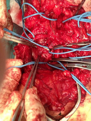Fístula arteriovenosa vista do interior da veia poplítea, após a venotomia.