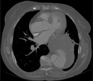 Dissecção crónica complicada de aneurisma aorta torácica descendente.