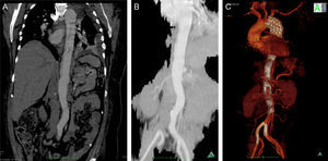 A, B e C: dissecção aórtica Stanford tipo B complicada de oclusão artéria ilíaca comum direita e artéria renal esquerda pré (A, B) e (C) pós‐procedimento.