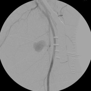 Angiografia demonstrando o falso aneurisma e seu colo para ramo da artéria femoral profunda.