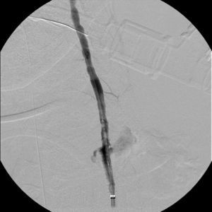 Angiografia de subtração digital, já após colocação do stent coberto no segmento V1, detetou‐se a presença de segundo foco hemorrágico no segmento V2da artéria vertebral.