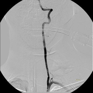 Angiografia de subtração digital, já após colocação de ambos os stents cobertos, em que se verifica ausência de hemorragias e restituição anatómica da vascularização cerebral posterior.