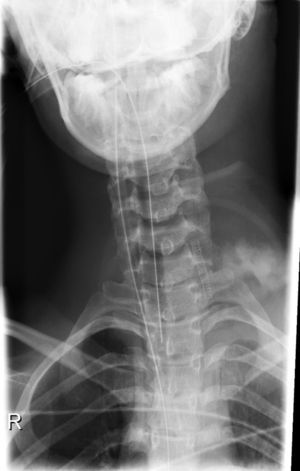 Radiografia cervical com imagem dos stents na artéria vertebral esquerda.