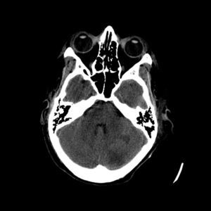 No estudo efetuado observam‐se 2 áreas de hipodensidade cerebelosas esquerdas, em relação com isquemia atendendo ao tempo sem fluxo.