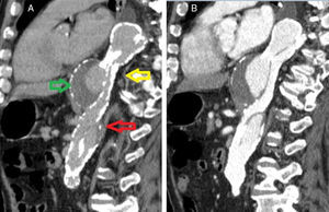 A. Aneurisma toraco‐abdominal (seta verde) pós‐dissecção crónica tipo B. Orifício de entrada (seta amarela). Orifício de reentrada (seta vermelha). B. Imagem com contraste.