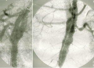 Arteriografia de controlo pós‐colocação de endoprótese tubular cónica, visualizando‐se preenchimento retrógrado do falso lúmen.