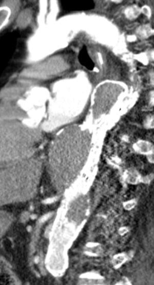 Angio TC em D4, observando‐se trombose do falso lúmen havia e exclusão do aneurisma.