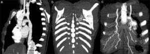 Reformatações MIP de angio‐TC do tórax em examinada com coartação da aorta. a) Reformatação sagital demonstrando zona de estenose na região do istmo aórtico, após a emergência da artéria subclávia esquerda. b) e c) Reformatações no plano coronal, evidenciando, respetivamente, aumento de calibre das artérias intercostais e das artérias mamárias internas.