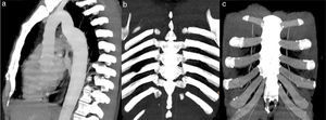 Reformatações MIP de angio‐TC do tórax em examinado com pseudocoartação da aorta. a) Reformatação sagital demonstrando alongamento do arco aórtico com acotovelamento na região do istmo, condicionando apenas discreta redução do calibre do vaso. b) e c) Reformatações no plano coronal, evidenciando ausência de aumento de calibre das artérias intercostais, apresentando as artérias mamárias internas calibre normal.