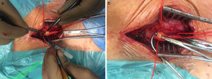 Imagem intraoperatória da dissecção da artéria carótida comum.