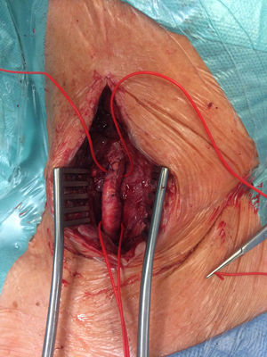 Imagem intraoperatória do aspeto final da artéria carótida comum.