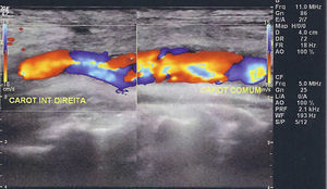 Eco‐Doppler: controlo após correção da dissecção; regularidade do lúmen da artéria carótida comum.