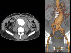 Pre-operative CTA, 10cm infra-renal aorto-iliac aneurysm.
