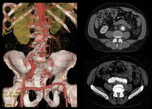 9-month post-operative control CTA, revealing a complete aneurysm regression.