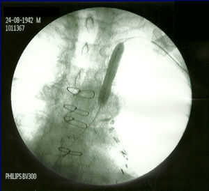 Angiografia: colocação de stent expansível por balão na artéria subclávia esquerda.
