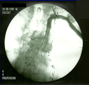 Angiografia: controlo final, após correção de estenose – artéria subclávia esquerda permeável sem estenose residual.