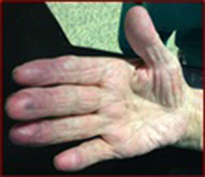 Patient with cyanotic fingers at the right hand.