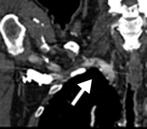 CT scan showing the atherosclerotic plaque at the right subclavian artery.