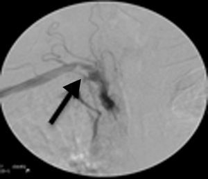 Angiography demonstrating an irregular atherosclerotic plaque at the right subclavian artery.