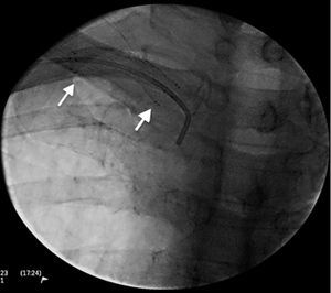 Stenting at the right subclavian artery.