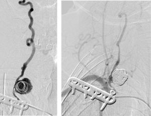 Imagens embolização aneurisma sacular vertebral com coils (Serviço de Neurorradiologia H. S. José).