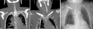 Imagens angioTC e radiografia tórax no 2.° dia de pós‐operatório.