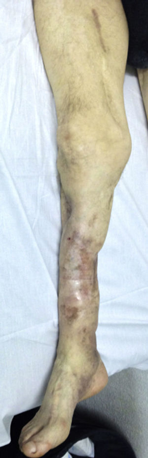 Severely deformed limb with multiple previous fractures, cutaneous grafts, chronic osteomyelitis and complete paralysis of the external sciatic nerve as a sequel of a remote trauma.