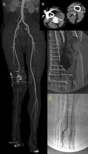 CTA image. (A) Reconstruction showing a permeable pseudo-aneurysm of the distal SFA. Bone fixation material artefacts at the level of popliteal artery. TPT permeable with a peroneal artery as the only distal vessel. Anterior and posterior arteries totally occluded from the beginning. (B) Axial view showing the 76mm diameter pseudo-aneurysm with mural thrombus and calcification. (C) Diagnostic angiography showing the pseudo-aneurysm of the SFA – 1st portion of the popliteal artery, 2nd portion occluded with repermeabilisation of the 3rd portion. (D) The peroneal artery was the only outflow vessel.