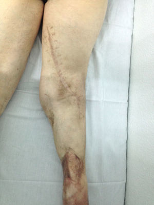 Image after 1 month discharge showing the limb with the proximal extension of the posterior approach.