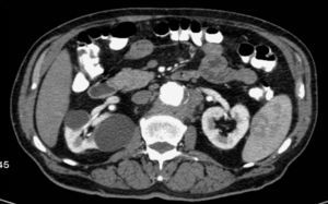 Pre-operatory CT scan showing an inflammatory mass surrounding the aneurysm and enclosing the left renal artery's ostium.