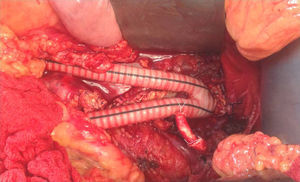 After partial aneurysm resection, using a bifurcated Dacron graft, an aorto-bifemoral interposition and a bypass to the left renal artery were accomplished.